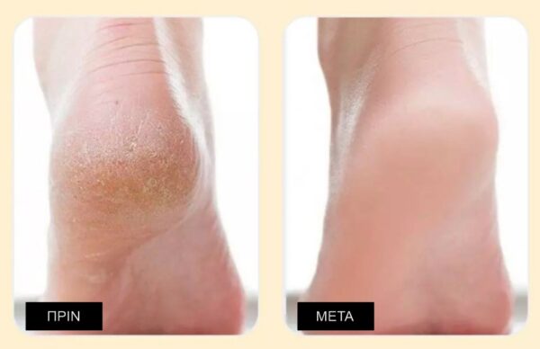 MEDI-PEEL EGF Scaling Moisture Foot Cream 2.0 130gr